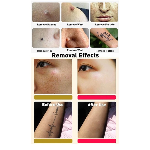 NEATCELL Picosecond Skin Laser Beauty Machine Tattoo Spot Removal Pigment Pen - Picture 5 of 6